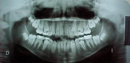 Radiografía de una dentición mixta